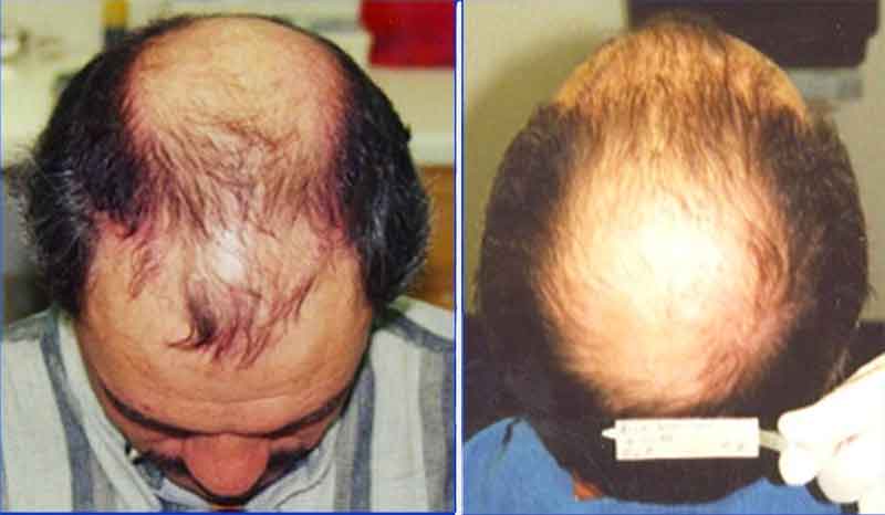 hair mass index transferred before