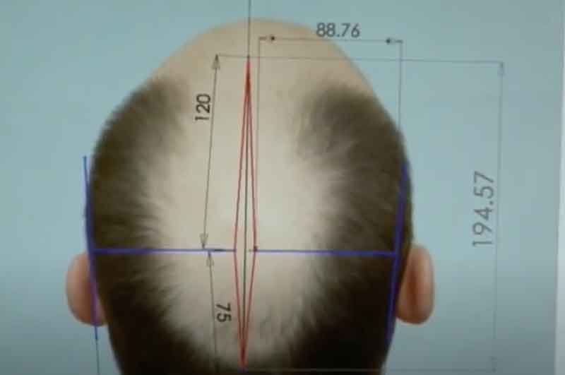 scalp donor area streching