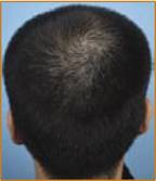 Korean donor area with the hair cut