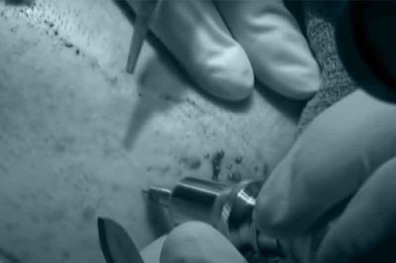 Smallest FUE punches