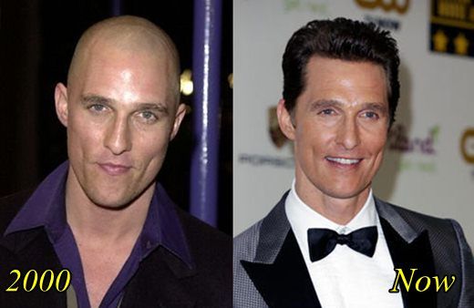 hair transplant celebreties matthew mcconaughey before and after