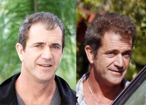 hair transplant celebreties mel gibson before and after