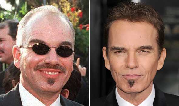 Celebrity Hair Transplants are on the Rise | Forhair
