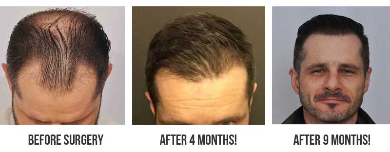 fast hair transplant growth timeline