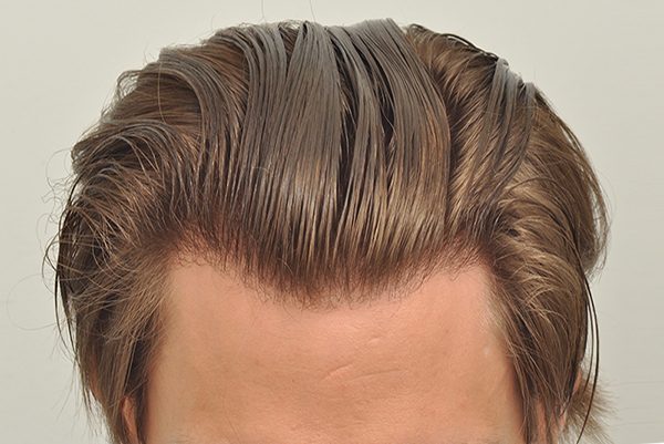 Hair Transplant Hairlines The Complete Guide Forhair