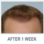 After 1 week