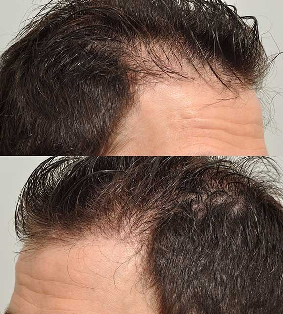 Hairline SMP