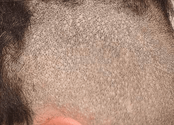 Before hair transplant