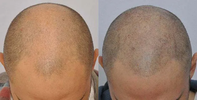 SMP before-after