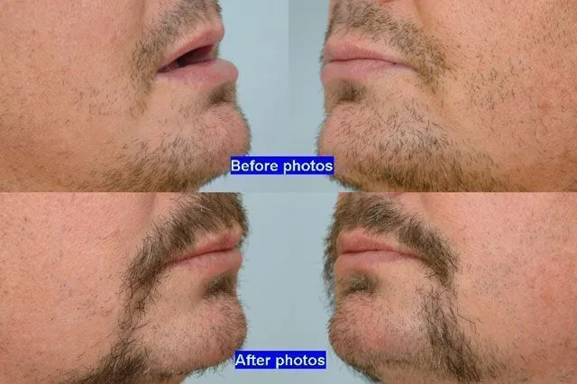 Body hair extraction from beard - before and after