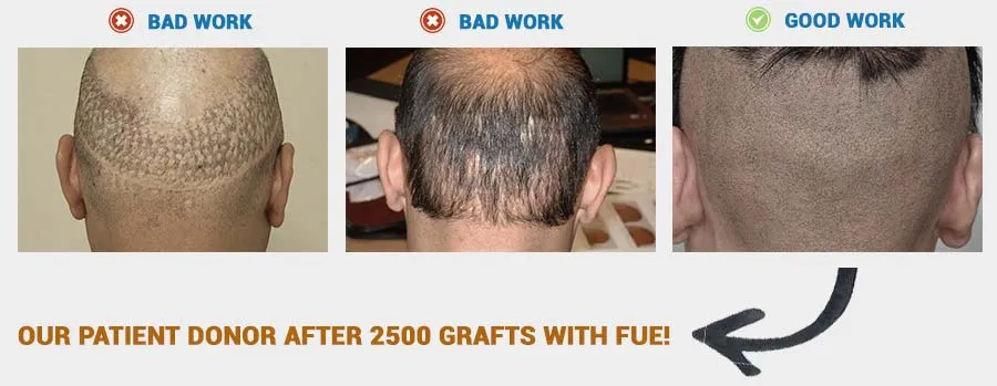 FUE Hair Transplant CIT