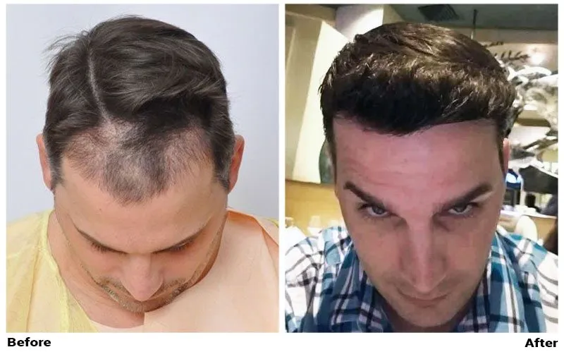 FUE Hair Transplant CIT