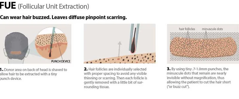 FUE follicular unit extraction