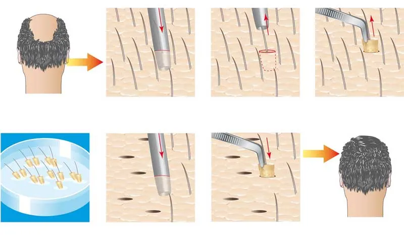 FUE Hair Transplant Procedure