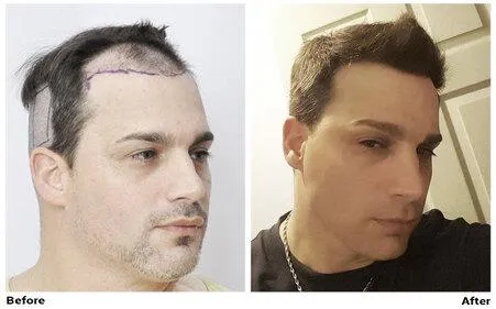 FUE Hair Transplant - CIT Patient