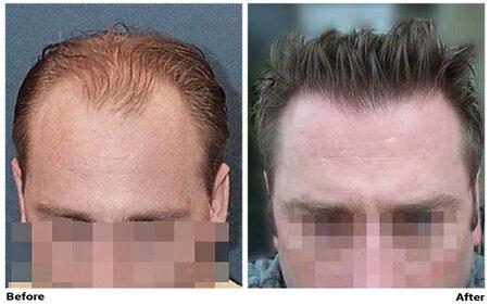 New York City Hair Transplant Clinic | Dr. Cole | Forhair New York City Hair Transplant Clinic | Dr. Cole | Forhair