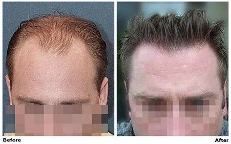 FUE Hair Transplant - CIT Patient 2