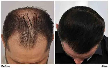 FUE Hair Transplant - CIT Patient 4