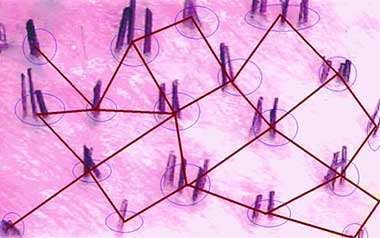 The number of grafts you require for hair transplant