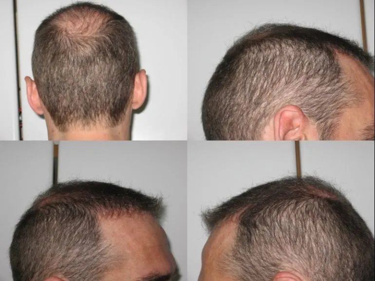 Hair Transplant Repair Using CIT® | Dr. Cole FUE | Forhair
