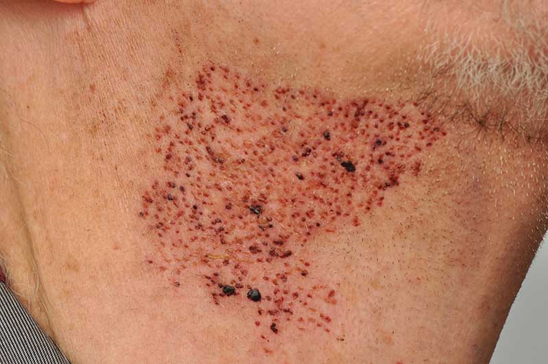 Body hair extraction from beard - after