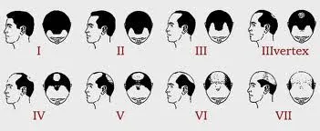 Norwood Scale types
