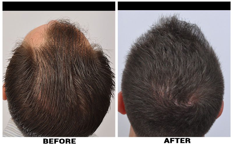 patient-eee-before-after-back