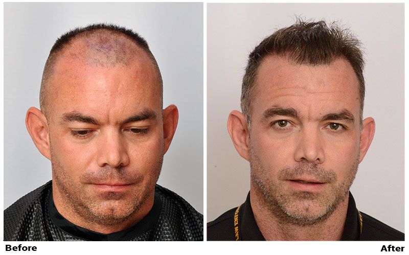 patient-mil-before-after-tillled-down-front3