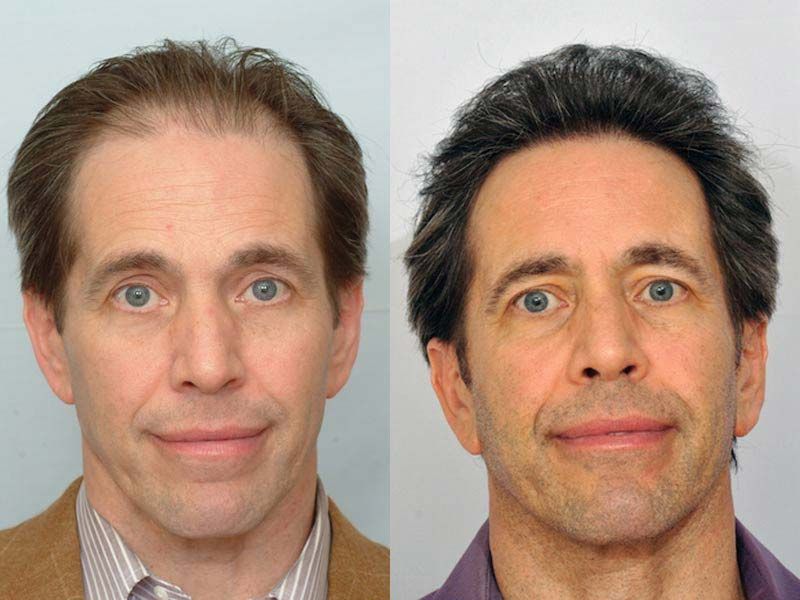 patient-ppp-before-after-full-face