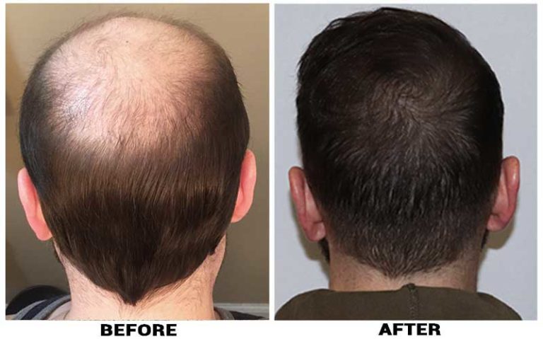 patient-pue-before-after-back