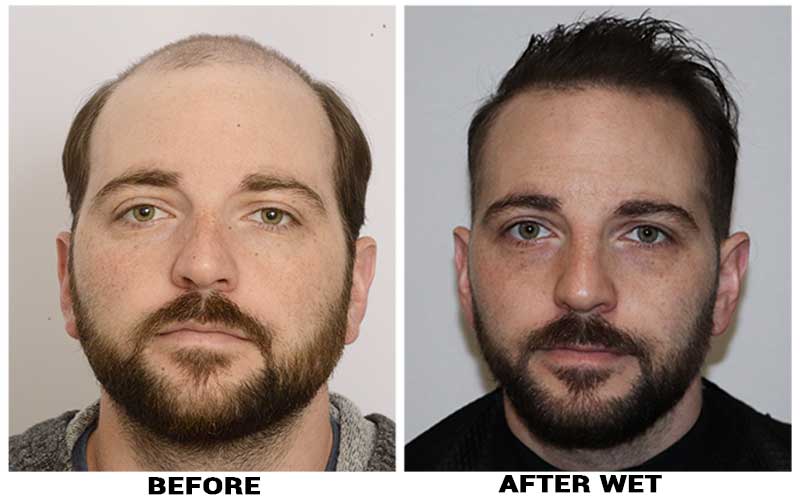patient-pue-before-after-front-wet
