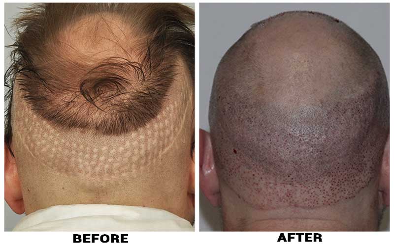 Scalp Micro Pigmentation