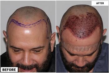 before-after-graft-placement