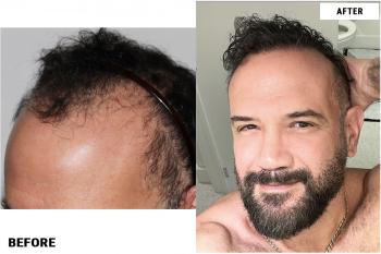 before-after-left3