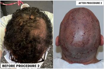 before-after-procedure-2