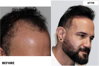 before-after-right2