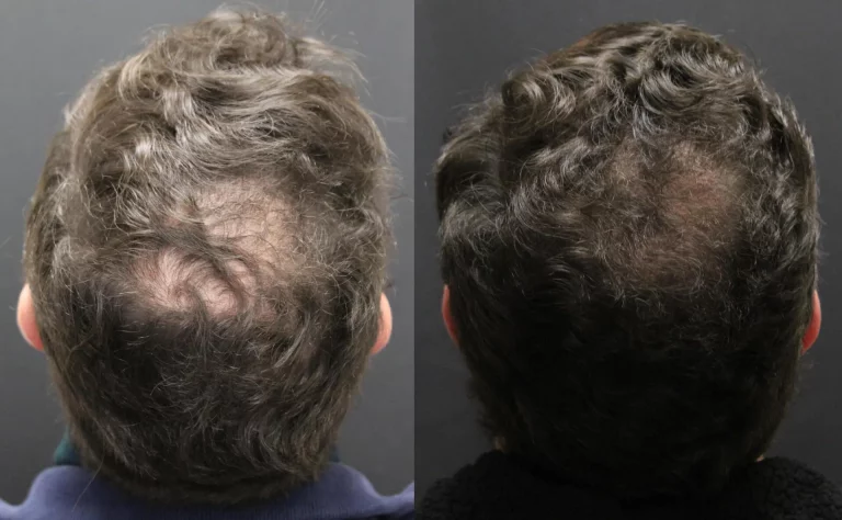 Hair Restoration Patient