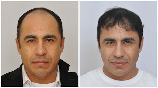 patient-vvc-comparison-front-down