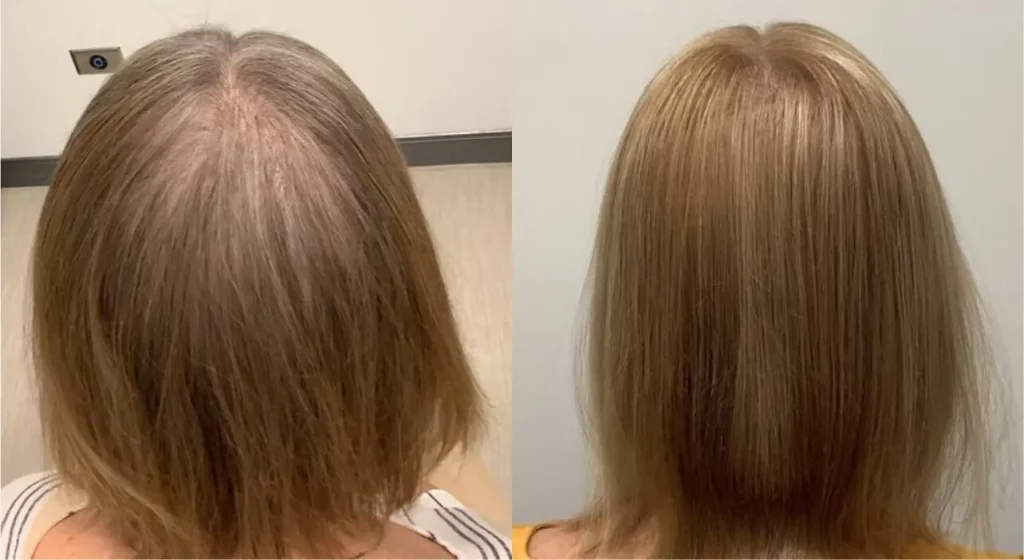 Female Hair Restoration Patient
