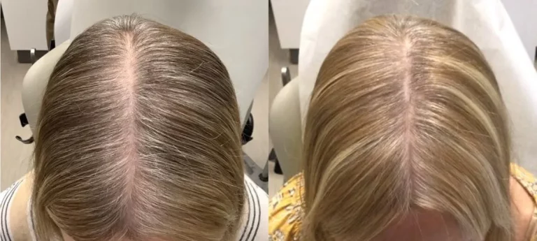 Female Alma TED Hair Restoration Patient