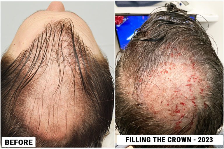 patient-rpe-before-after-2nd-crown
