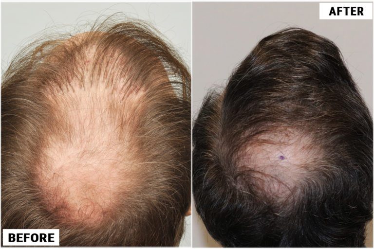 patient-rpe-before-after-crown2