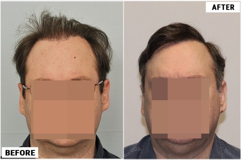 Patient RPE before and after photo comparison