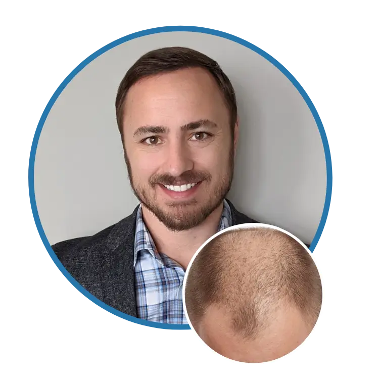 Hair Transplant Surgeon in NYC, New York - Patient Results