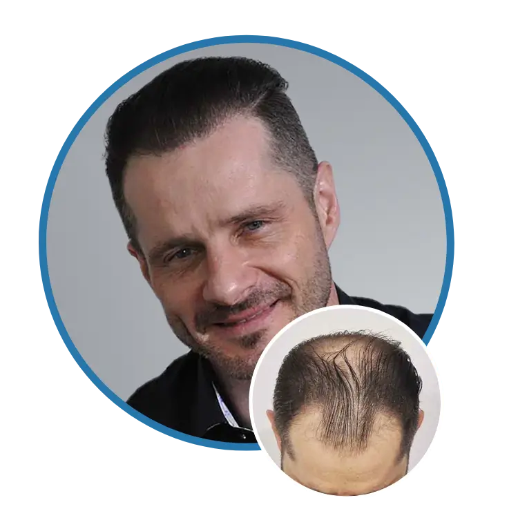 Hair Transplant Clinic in NYC, New York - Patient Review