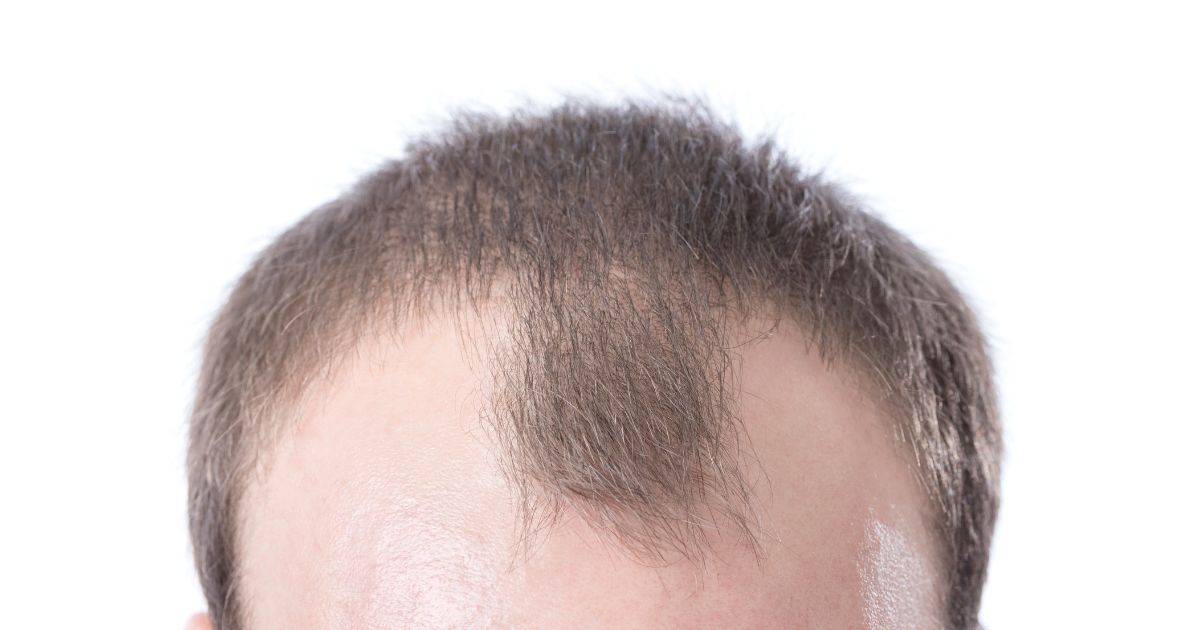 A lot of factors contribute to receding hairline