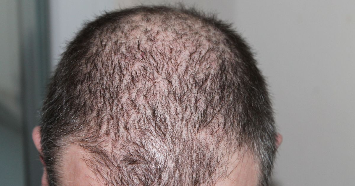 Solve hair loss problems with an experienced hair transplant surgeon. 