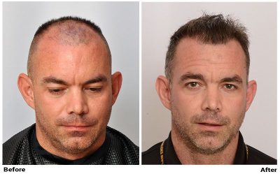 patient-mil-before-after-tillled-down-front3