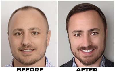 Free Online Consultation For Your Hair Restoration | Forhair